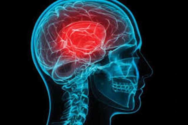 Ανεύρυσμα εγκεφάλου: Τα «αθώα» σημάδια που… φωνάζουν και αγνοούμε! - Media