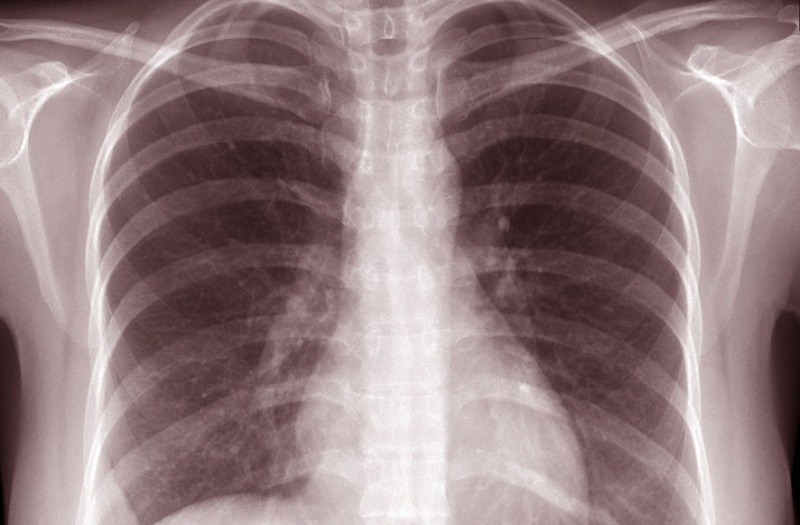 Στοιχεία-σοκ: Η φυματίωση συνεχίζει να απειλεί ζωές - Media