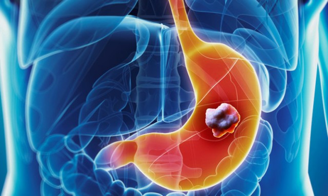 Καρκίνος του στομάχου: Προσοχή στα «αθώα» συμπτώματα! - Media
