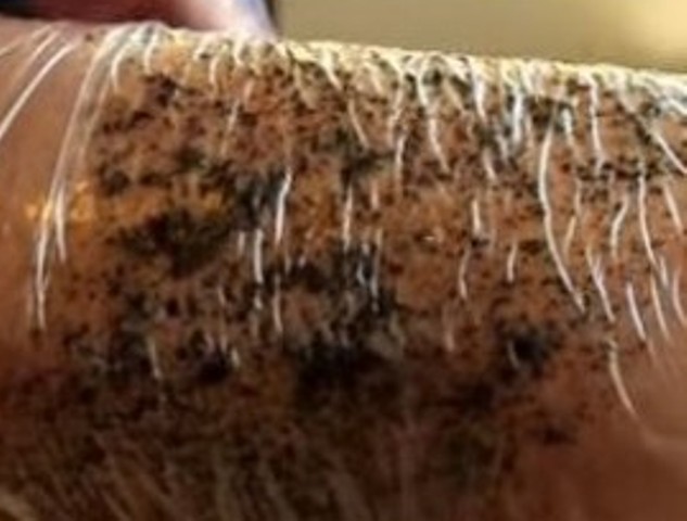 Κυτταρίτιδα: Απαλλαχθείτε άμεσα με τον πιο φυσικό τρόπο!  - Media