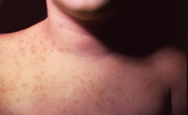 Νέο κρούσμα μηνιγγίτιδας Β στο Χαϊδάρι - Media