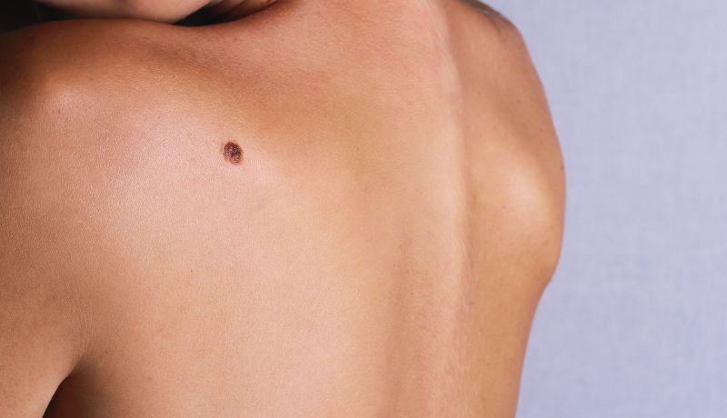 Προσοχή: Πότε οι ελιές στο δέρμα είναι επικίνδυνες - Media