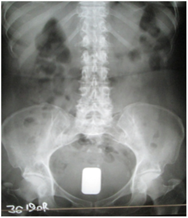 Επιχείρησαν να περάσουν ράβδους χρυσού από το τελωνείο κρύβοντας τες στον πρωκτό τους (Photos)  - Media