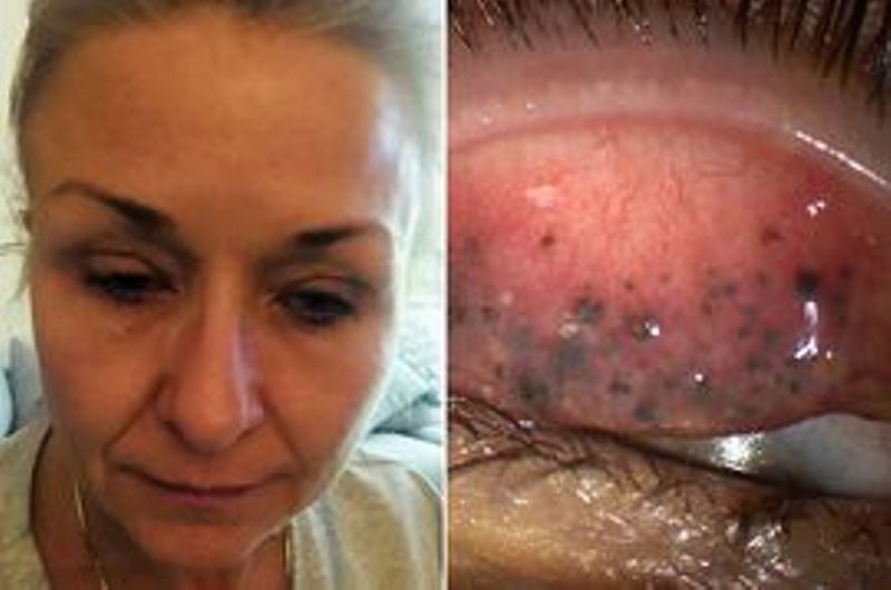 Για 25 χρόνια δεν έβγαζε τη μάσκαρα από τα μάτια της – Δείτε τι έπαθε (Σκληρές Photos) - Media