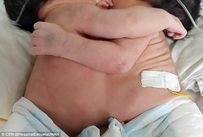 Νεογέννητα σιαμαία, μοιράζονται καρδιά και συκώτι – Οι γιατροί δεν μπορούν να τα διαχωρίσουν γιατί θα πεθάνουν (Photos) - Media