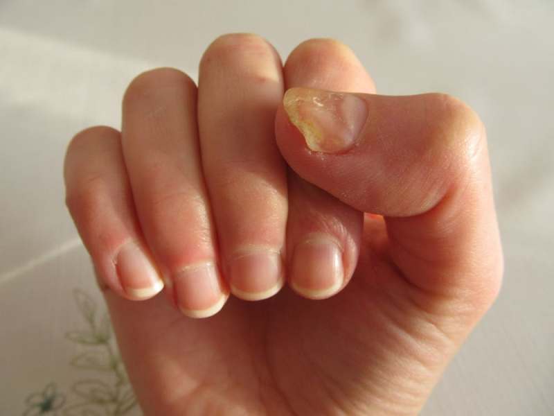 Προσοχή στις μυκητιάσεις στα νύχια - Πότε γίνονται επικίνδυνες - Media