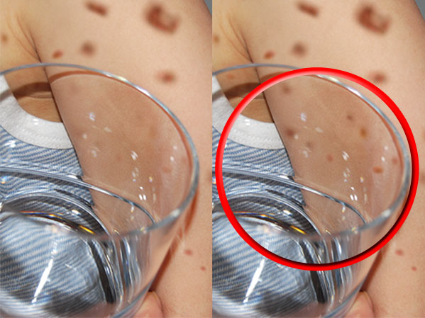 Μηνιγγίτιδα – Σημάδι στο δέρμα: Πώς γίνεται επιτόπου το «τεστ με το ποτήρι» (Video) - Media