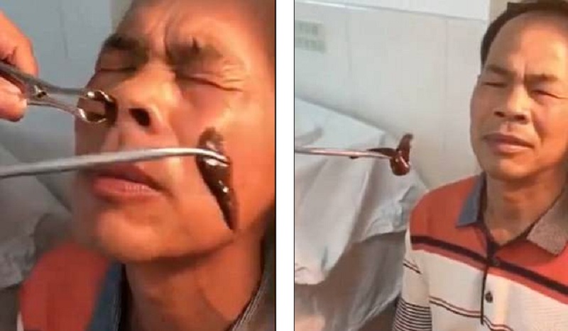 Γιατρός έβγαλε μέσα από τη μύτη ασθενούς, μια τεράστια βδέλλα (Video) - Media