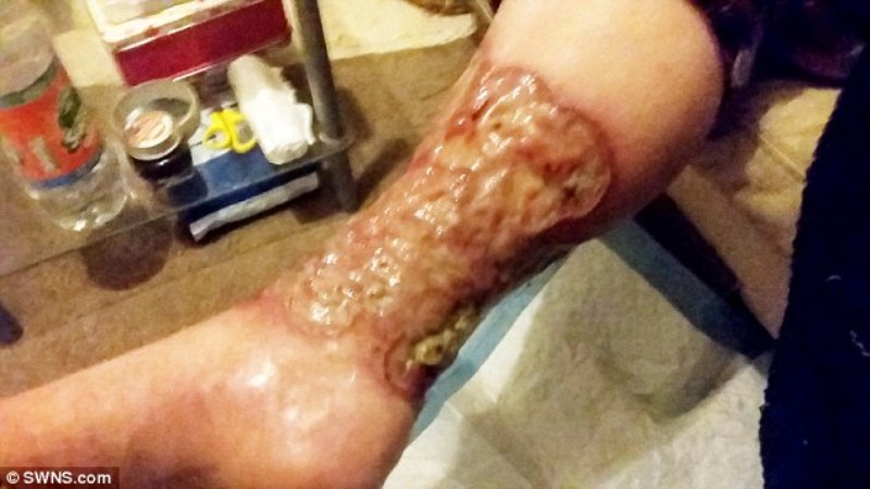 Γυναίκα ξύρισε το δεξί της πόδι και μολύνθηκε – Της το έκοψαν και τώρα φοβάται να ξυρίσει και το αριστερό - Media