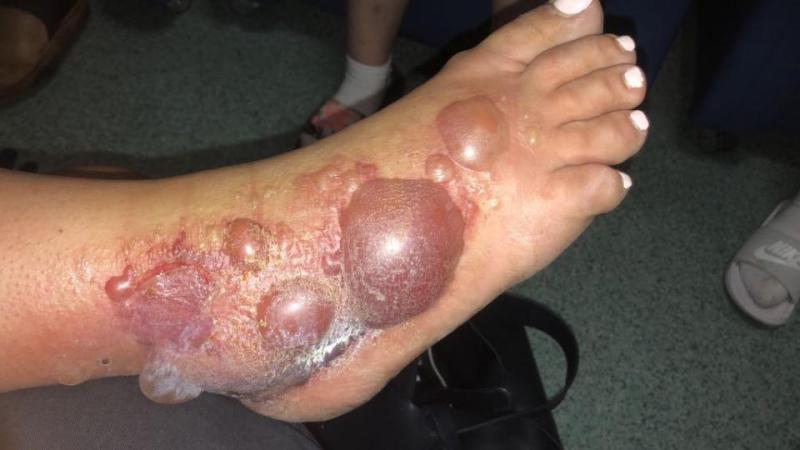 Έτσι έγινε το πόδι της μετά από τσίμπημα αλογόμυγας (Photos) - Media