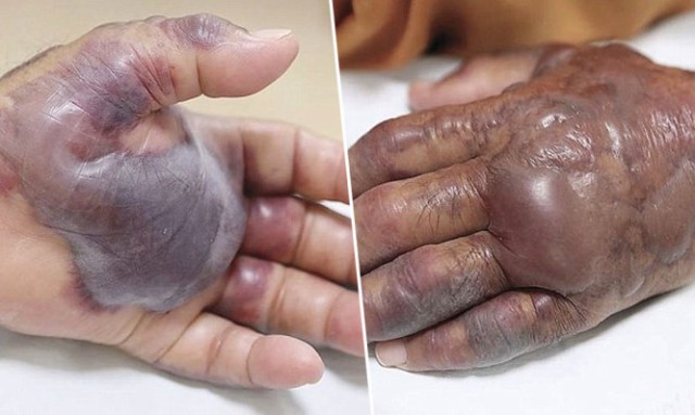 Έφαγε ωμά θαλασσινά και μολύνθηκε: Τον ακρωτηρίασαν για να σωθεί! - Media