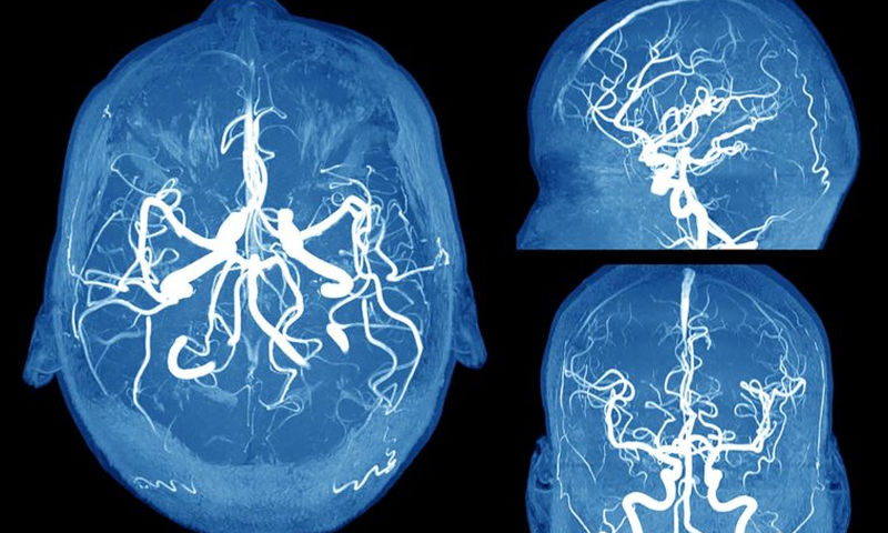 Ανεύρυσμα εγκεφάλου: Τα συμπτώματα SOS που πρέπει να γνωρίζετε - Media