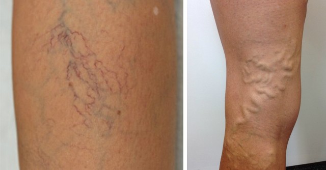 Πώς θα απαλλαγείτε από κιρσούς και ευρυαγγείες - Media