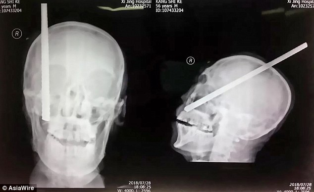 Αγοράκι δάγκωσε συμπαίκτη του στο ποδόσφαιρο και το δόντι του καρφώθηκε στο… κρανίο του - Media