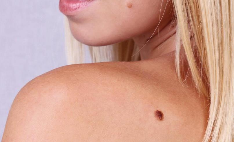 Καρκίνος του δέρματος: Τι σημαίνει φαγούρα σε ελιές - Media
