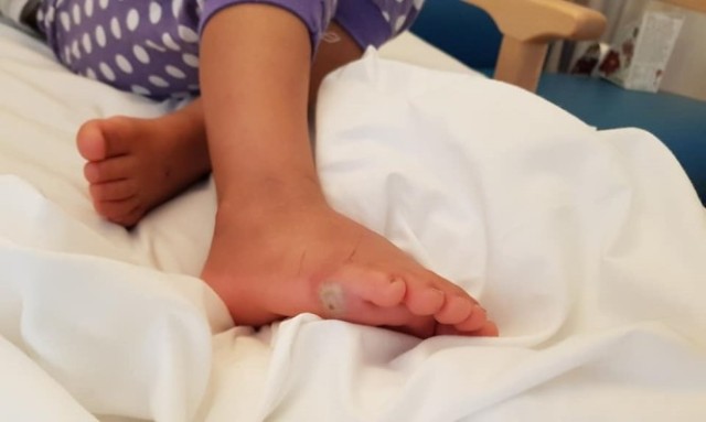 Τετράχρονη έβαλε καινούρια παπούτσια ξυπόλυτη και έπαθε σηψαιμία! - Media