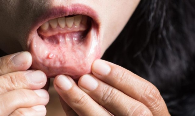 Καρκίνος του στόματος: Μην αγνοήσετε τα πρώτα «αθώα» συμπτώματα  - Media