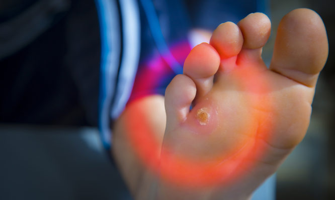 Κάλοι - σκληρύνσεις στα πόδια: Πώς θα απαλλαγείτε  - Media