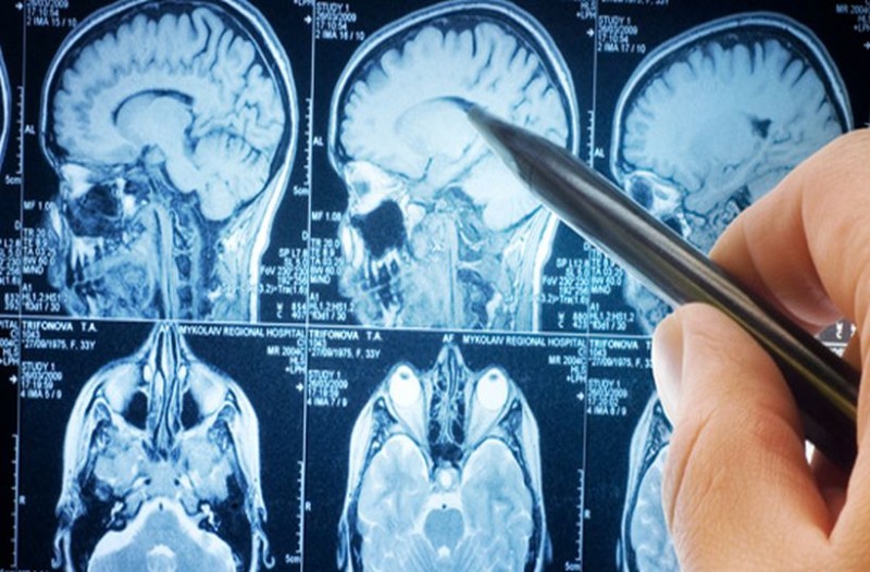 Εγκεφαλίτιδα: Η «ύπουλη» φλεγμονή του εγκεφάλου - Τα πρώτα συμπτώματα - Media