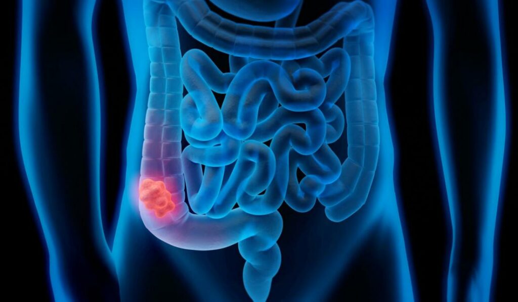 Καρκίνος του παχέος εντέρου: Οι πιο «επίφοβες» ηλικίες - Τα κρίσιμα πρώιμα συμπτώματα - Media