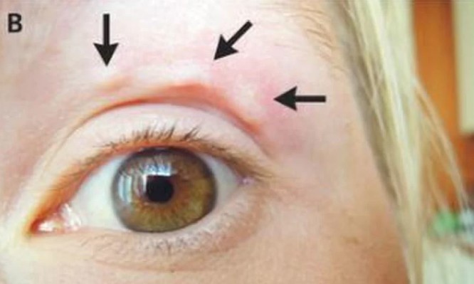 Είδε ένα εξόγκωμα στο μάτι της: Ο γιατρός βρήκε μέσα στο δέρμα της… σκουλήκι! (Photo) - Media