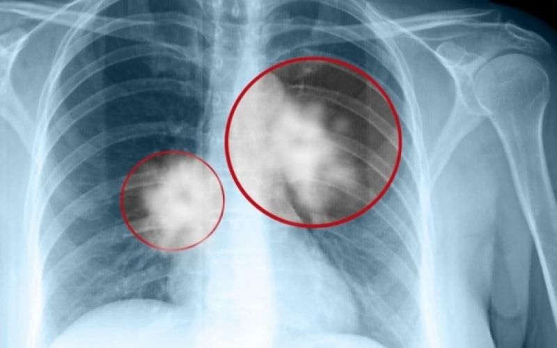Καρκίνος του πνεύμονα: Τα δύο σημάδια που δεν πρέπει να αγνοήσετε - Media