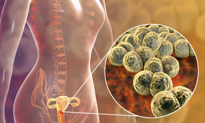 Τραχηλίτιδα: Η «ύπουλη» νόσος των γυναικών - Προσοχή στα «αθόρυβα» συμπτώματα - Media
