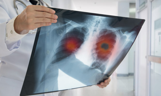 Καρκίνος του πνεύμονα: Το «ύπουλο» σημάδι που προειδοποιεί - Media