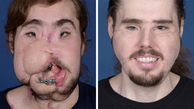 «Έχω ξανά μύτη και στόμα»: Απίστευτη μεταμόσχευση προσώπου σε 26χρονο που παραμορφώθηκε σε απόπειρα αυτοκτονίας (Photos) - Media