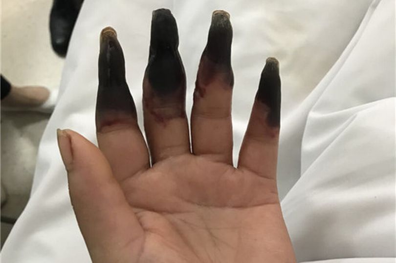 Έκανε δουλειές στο σπίτι και τα δάχτυλά της… μαύρισαν (Σκληρές Photos) - Media