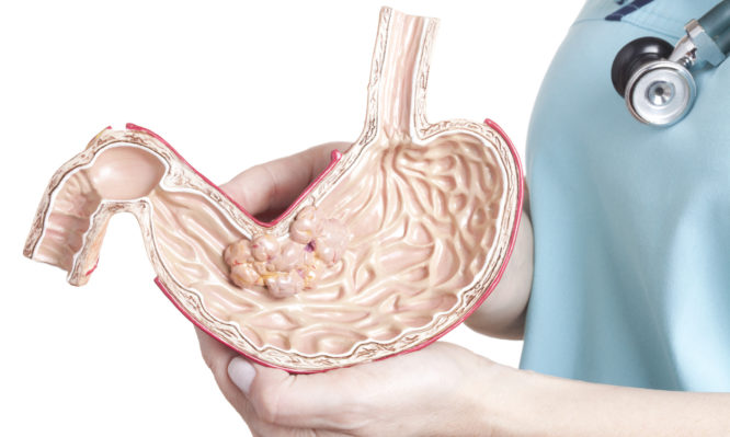 Ελπιδοφόρα τα νέα για τον καρκίνο στομάχου: Το φάρμακο που κάνει «θαύματα» - Media