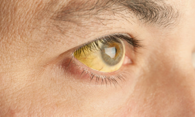 Κίτρινα μάτια: Ποιο πρόβλημα υγείας «μαρτυρούν» - Ποιοι πρέπει να προσέχουν - Media