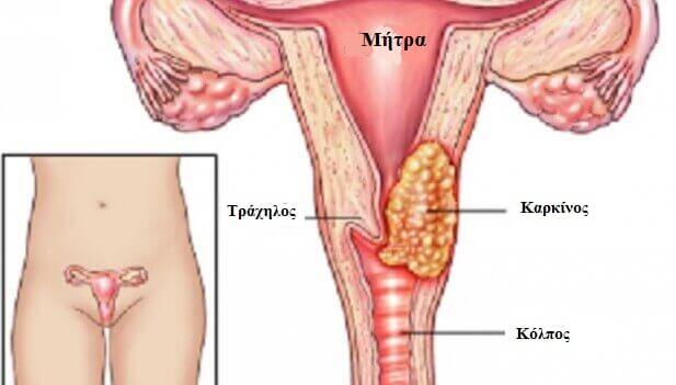 Καρκίνος τραχήλου: Το σύμπτωμα που δεν πρέπει ποτέ να αγνοήσετε! - Media