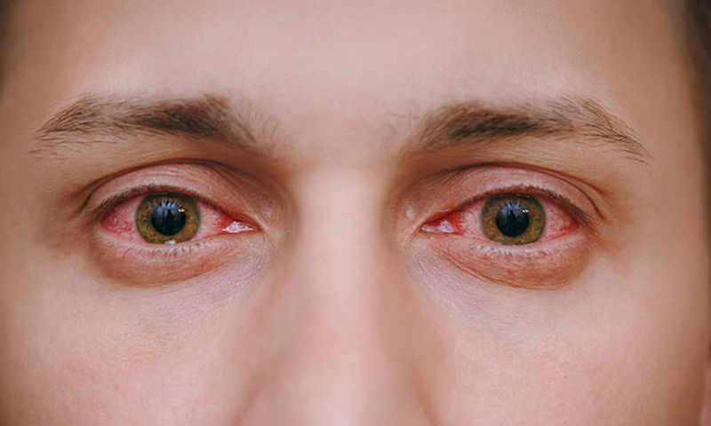 Κοκκίνισμα ματιών: 5 κοινές αιτίες & πώς θα το προλάβετε - Media
