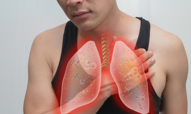 Καρκίνος του πνεύμονα και βήχας: Πώς συσχετίζονται - Media