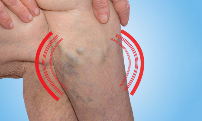 Φλεβική θρόμβωση: Ένας «σιωπηλός δολοφόνος» - Ποια τα πρώιμα συμπτώματα - Media