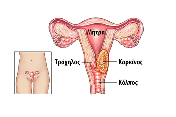 Πώς το σώμα της γυναίκας επιτίθεται στα σπερματοζωάρια  - Media