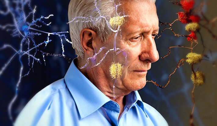 Αλτσχάιμερ: Οι τρεις τροφές που κάνουν «θαύματα» - Media