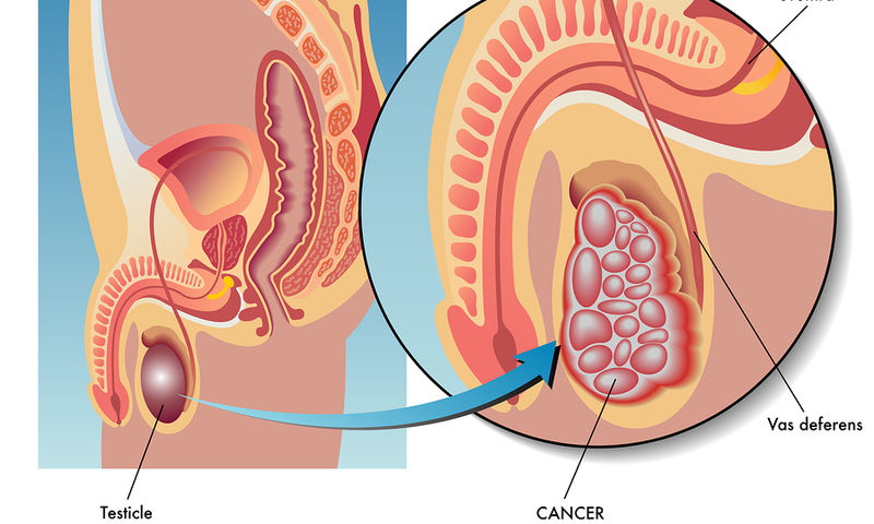 Καρκίνος των όρχεων: Ποια είναι τα πρώτα «αθώα» συμπτώματα - Media