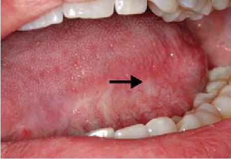 Ανησυχητική αύξηση παρουσιάζουν τα κρούσματα καρκίνου του στόματος - Media