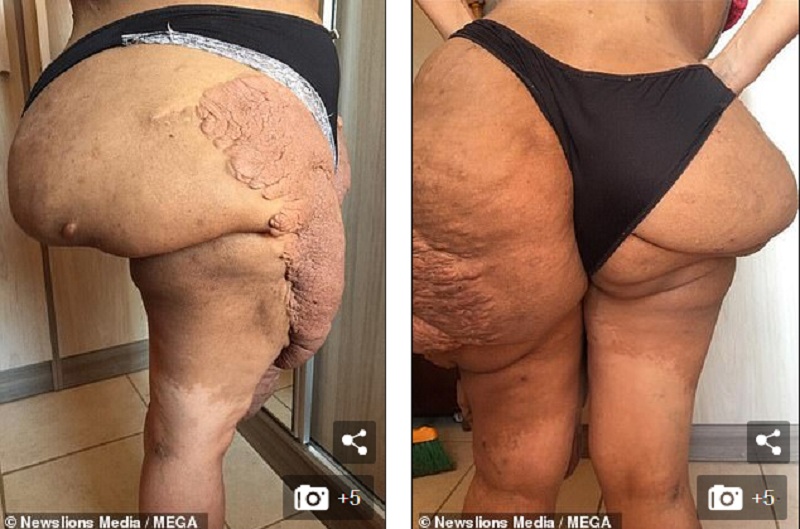 Μια τεράστια μάζα σάρκας στο πόδι γυναίκας της έχει καταστρέψει τη ζωή (Σκληρές Photos/Video) - Media