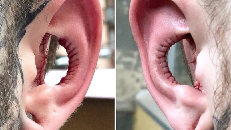 Νέα φρικιαστική μόδα: Ακρωτηριάζουν τα αυτιά τους για «αισθητικούς» λόγους (Photo) - Media