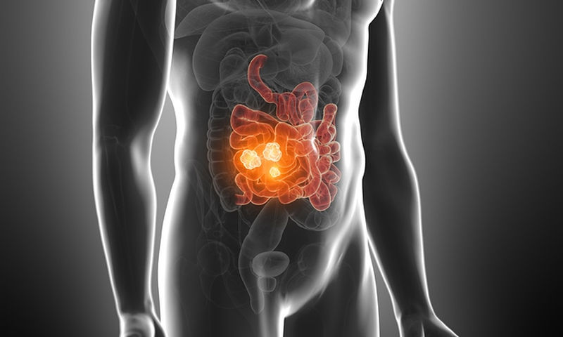 Καρκίνος εντέρου: Ποια τροφή σκοτώνει το 75% των όγκων σύμφωνα με νέα έρευνα - Media