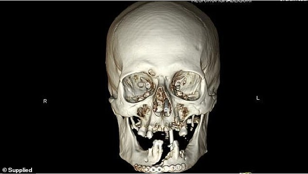 Του έφυγε το αλυσοπρίονο από τα χέρια την ώρα που έκοβε ξύλα και του διέλυσε το πρόσωπο (Photos) - Media