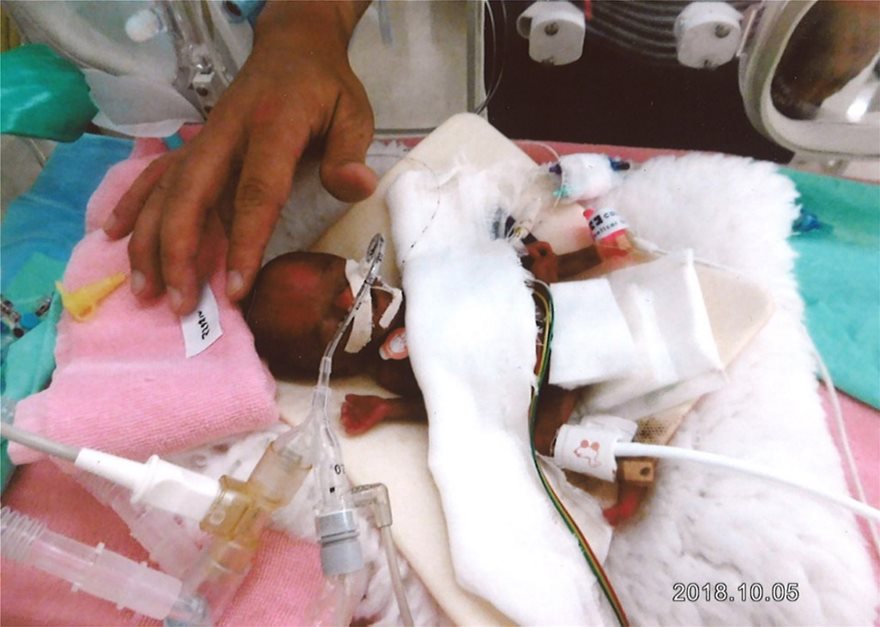 Ιατρικό «θαύμα» στην Ιαπωνία: Γεννήθηκε 258 γραμμάρια και έζησε (Photos) - Media