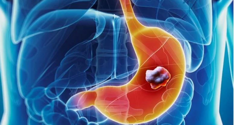 Καρκίνος στομάχου: Προσοχή στα πρώιμα συμπτώματα - Media