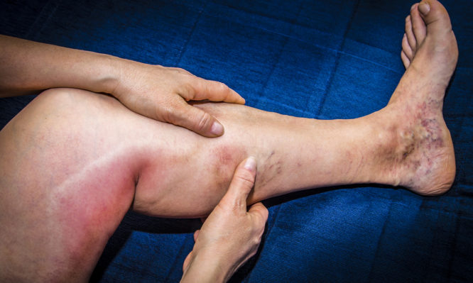 Πότε ξεκινάει η φλεβίτιδα – Ποια συμπτώματα θα προσέξετε - Media