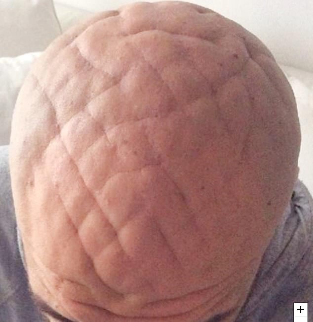 Σπάνια ορμονική διαταραχή κάνει το δέρμα του κεφαλιού του να μοιάζει με πάπλωμα γεμάτο ρόμβους (Photos) - Media