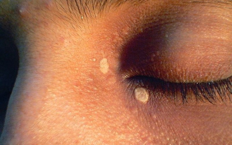 Ξανθέλασμα στα μάτια: Τι είναι – Πώς αντιμετωπίζεται - Media