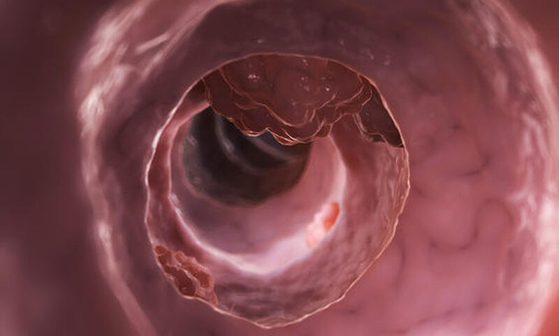 Καρκίνος εντέρου: Ποιες είναι οι ηλικίες που χτυπάει συχνότερα - Media